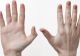 Simptomele cancerului apar prima dată pe mâini. Cum arată