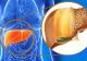 Semne că ficatul tău este plin de toxine - mergi de urgență la doctor dacă observi așa ceva!