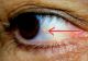 Dacă ți-a apărut așa ceva în ochi, fugi la doctor. Ce probleme grave de sănătate indică acest simptom