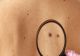 Regula simplă cu ajutorul căreia poți identifica din timp cancerul de piele