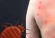 Semne că ai fost mușcat de ploșnițe. Cum să le deosebești de celelalte mușcături de insecte și cum să le tratezi