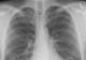 Ce este și cum se transmite „boala legionarilor”. Epidemie: cinci morți și peste 100 de cazuri confirmate